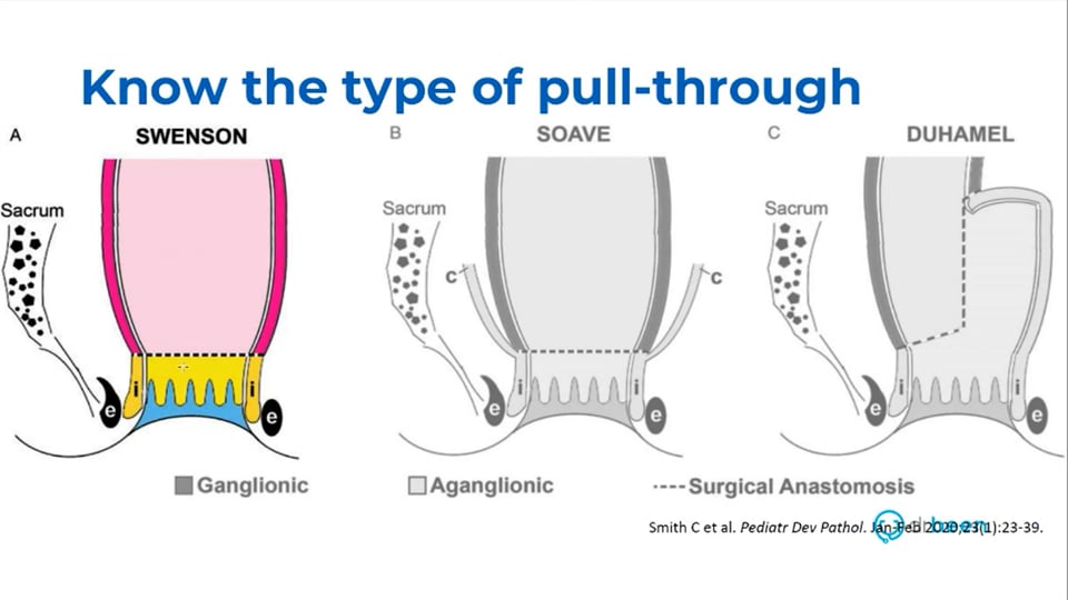 Hirschsprung - Long Terms Concerns (Pediatric Surgery Series Lecture 2) by Dr. Marc A. Levitt, MD