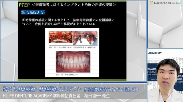 無歯顎者に対するインプラント治療、まとめ│歴史から学ぶ全部床義歯