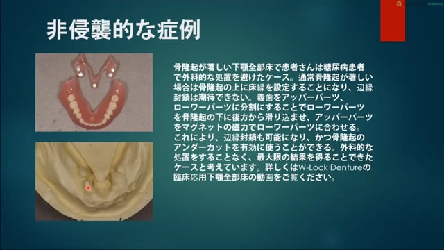 第6回 非侵襲的な症例 #1 骨隆起のある下顎全部床義歯症例