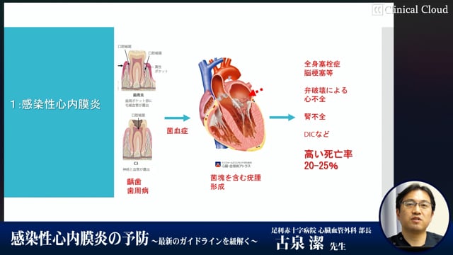 感染性心内膜炎の予防～最新のガイドラインを紐解く～