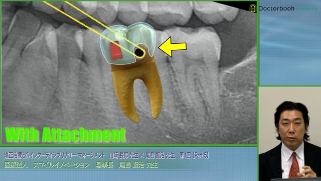 アライナー矯正におけるアタッチメントの役割 / 尾島賢治先生 #5