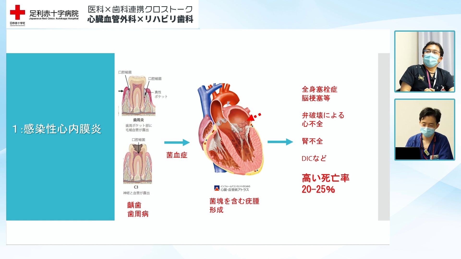 周術期口腔機能管理の目的と役割 感染除去方法としての抜歯基準