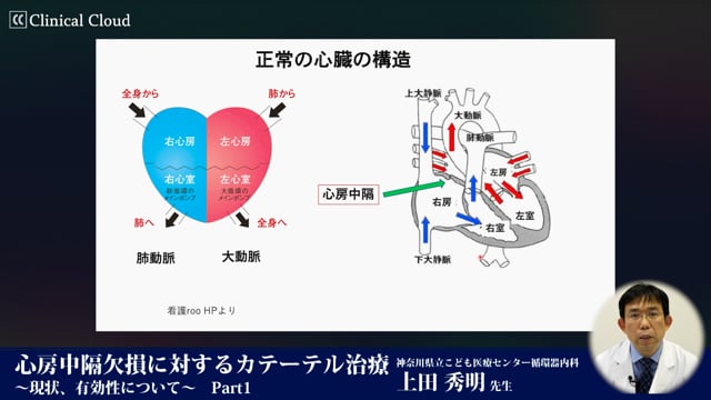 心房中隔欠損に対するカテーテル治療～現状、有効性について～ Part1