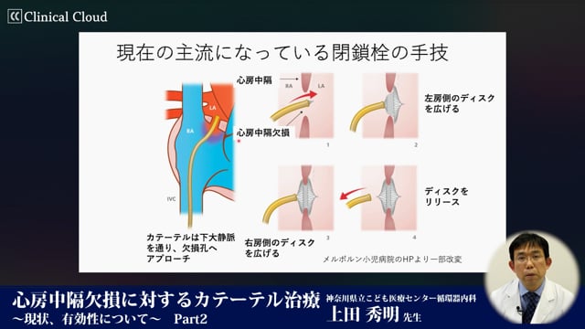 心房中隔欠損に対するカテーテル治療～現状、有効性について～ Part2 