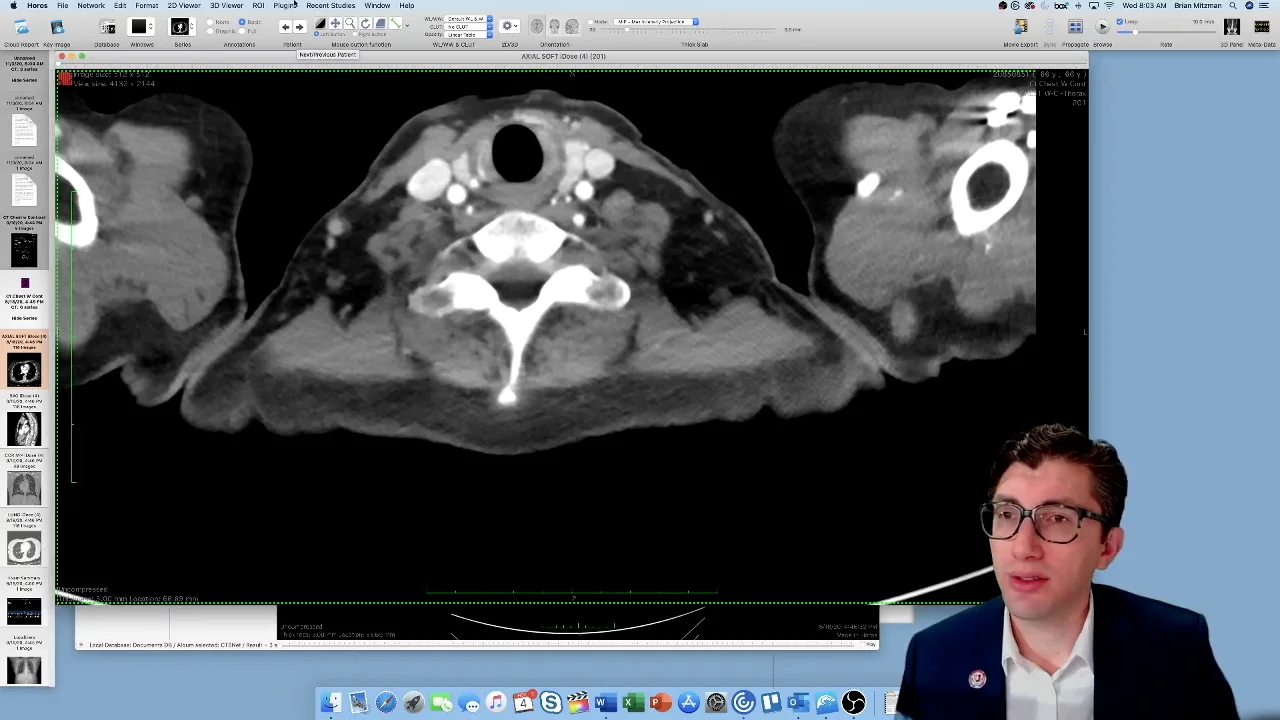 How-To: Creating a 3D Reconstruction of Your Patient's CT Scan, image size:1280x720