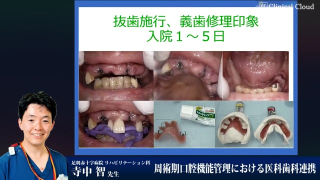 周術期口腔機能管理における医科歯科連携　Part2 