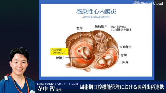 周術期口腔機能管理における医科歯科連携　Part1