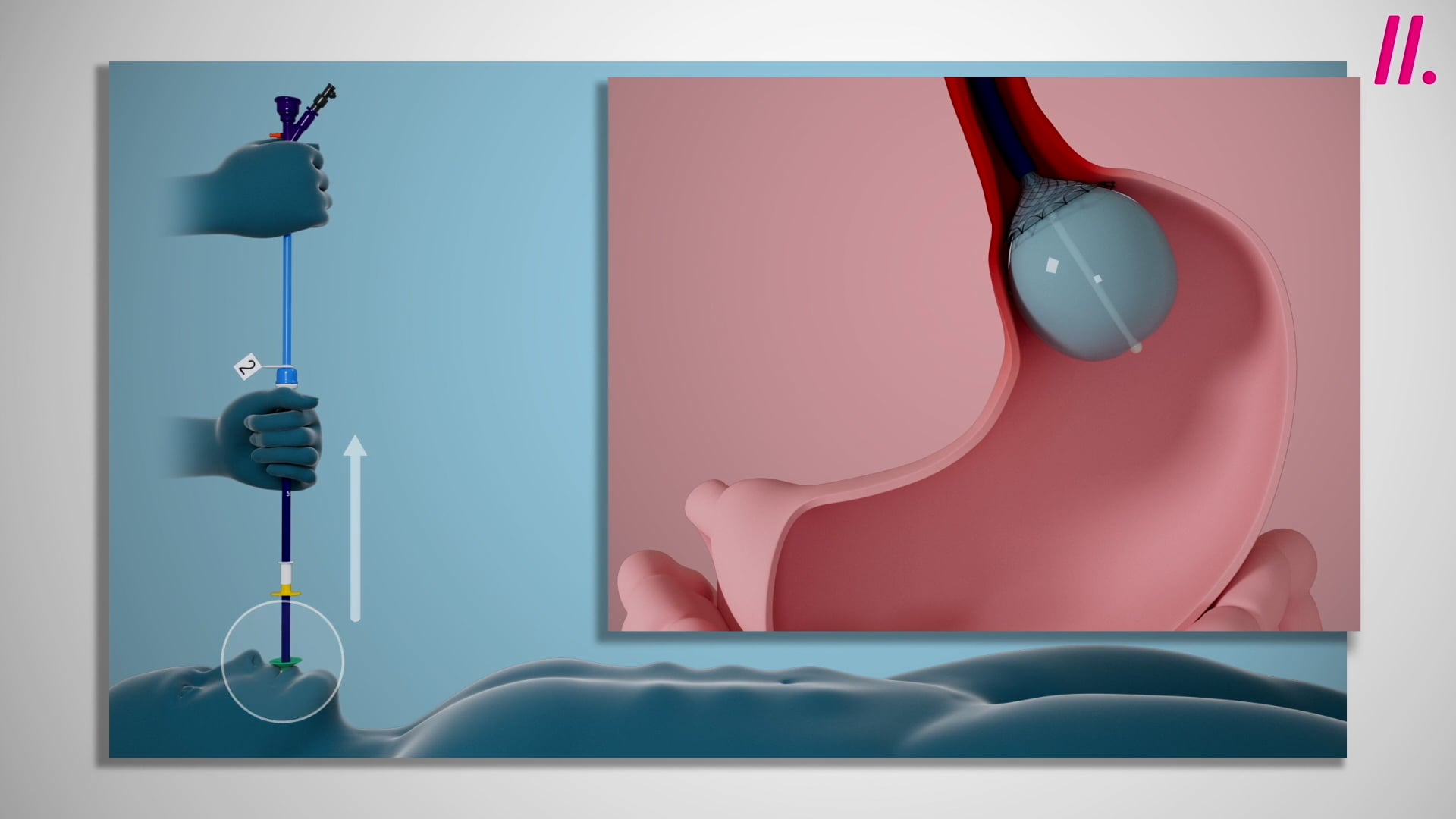 Danis Oesophageal Stent