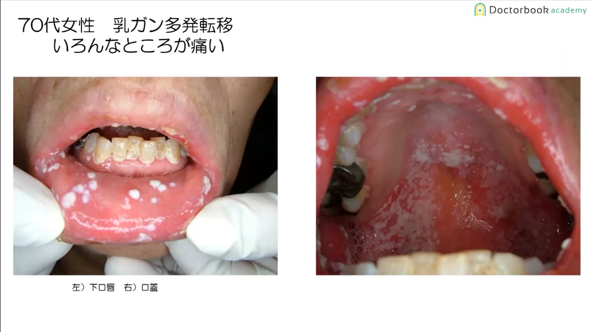 カンジダ症の診断とカンジダ関連病変について