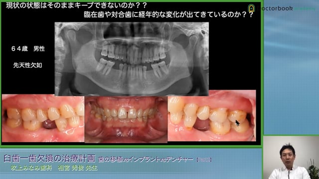 テトラサイクリン歯・叢生を伴う下顎前突症の咬合再構成│相宮秀俊先生 