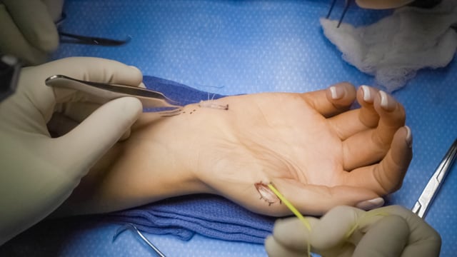 Thumb Opposition Tendon Transfer Using the Extensor Indicis Proprius (EIP) Tendon