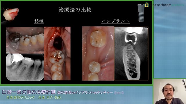 インプラント治療の13のルール│月星太介先生