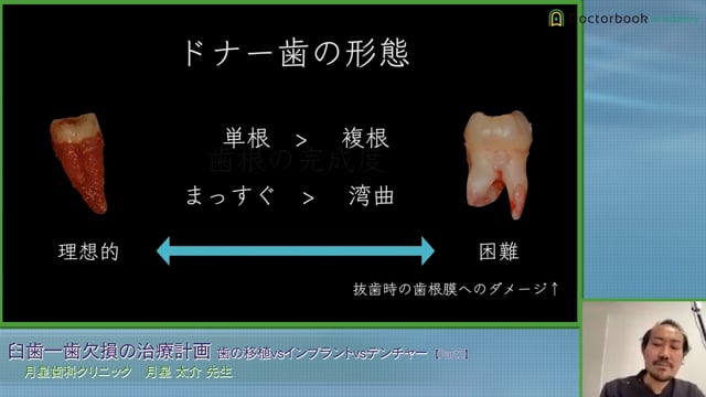 臼歯一歯欠損に対する治療方法と選択基準 ～わたしならこうする 