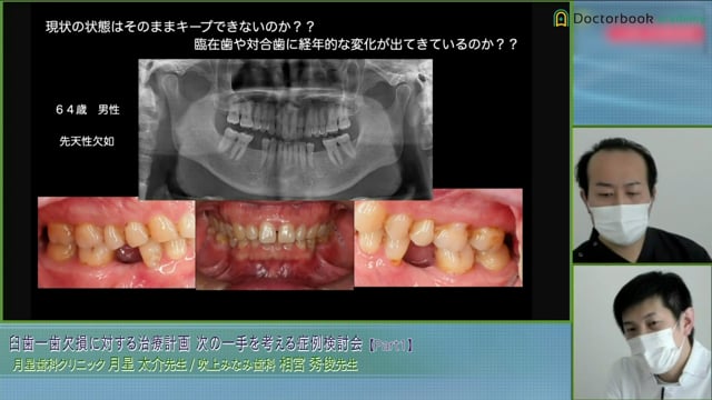 下顎1歯欠損の症例│次の一手を考える症例検討会