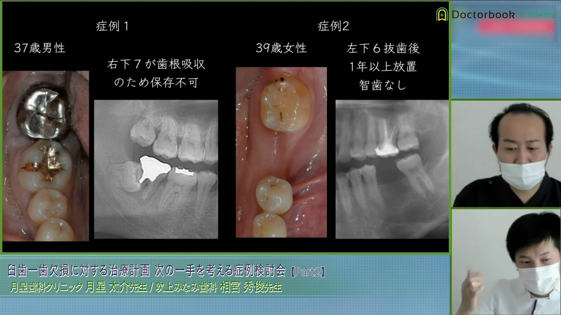 多数歯欠損・無歯顎症例のインプラント治療 - 健康・医学