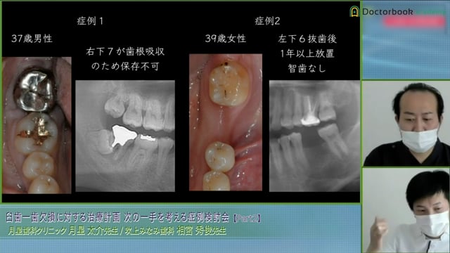 下顎1歯欠損でインプラントと歯牙移植をした症例│次の一手を考える症例検討会