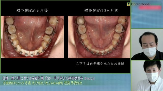 親知らず活用術│次の一手を考える症例検討会