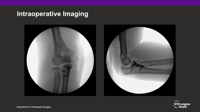 Operative Fixation of the Anteromedial Facet of the Coronoid Process