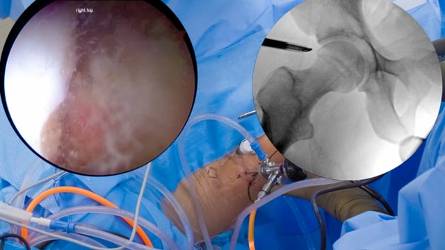 Hip Arthroscopy for FAI: The Femoroacetabular Impingement Resection (FAIR) Arc