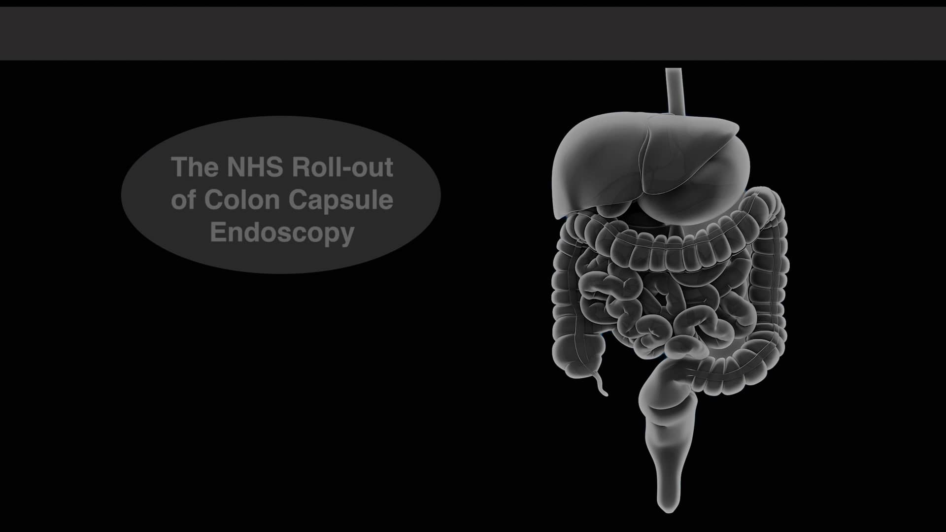 The NHS RollOut of Colon Capsule Endoscopy (CCE) and our changing
