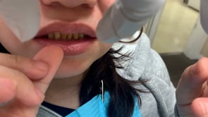 Upper Snap Denture