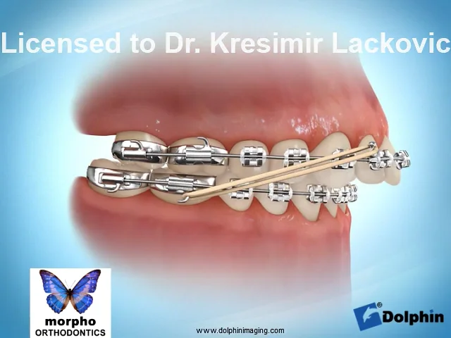 Elastics - Marin Ortho, Orthodontist, Larkspur