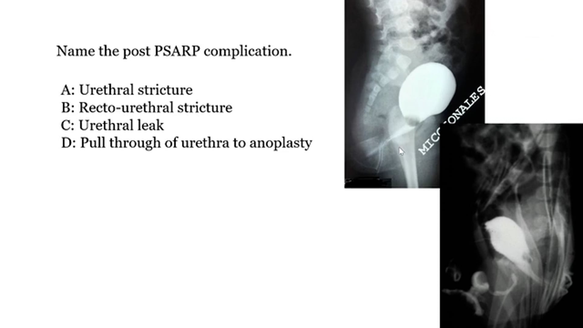 Postoperative Complications of Anorectal Malformations (Lecture 4) by Dr. Marc A. Levitt, MD 