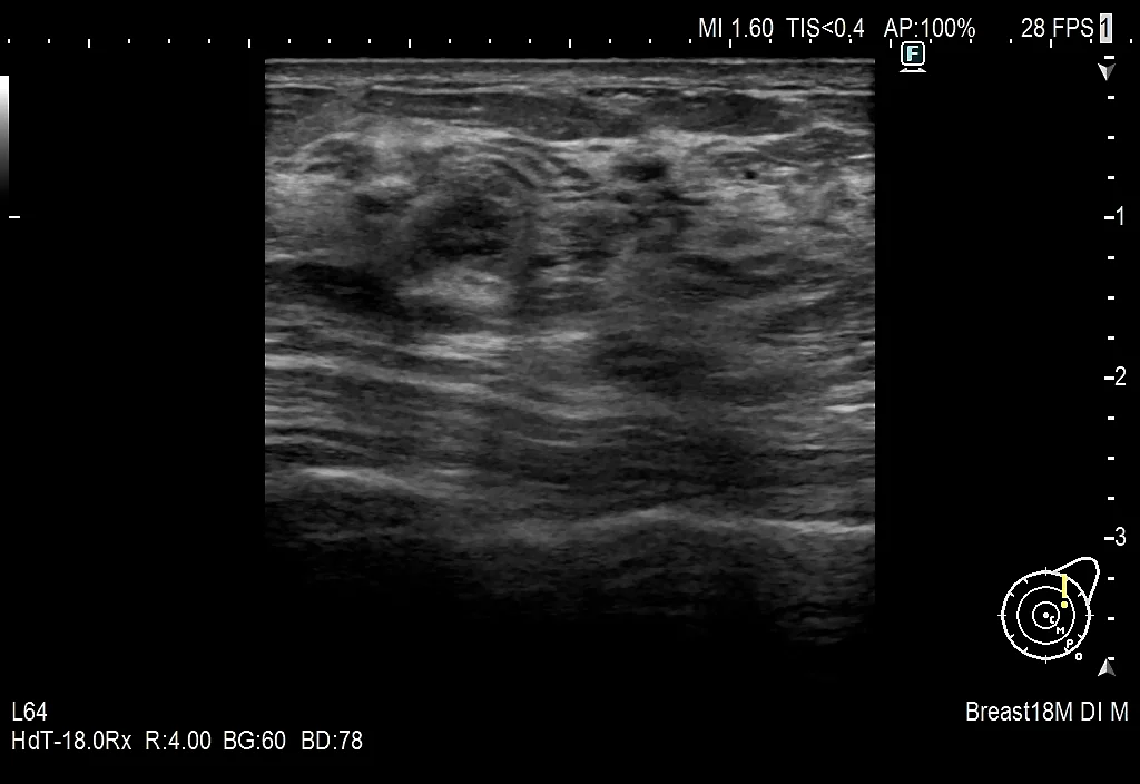 Breast Imaging：超音波診断装置 | 富士フイルム [日本]