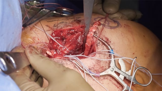 Coracoclavicular Ligament Injury: Combined Suture and Allograft Reconstruction