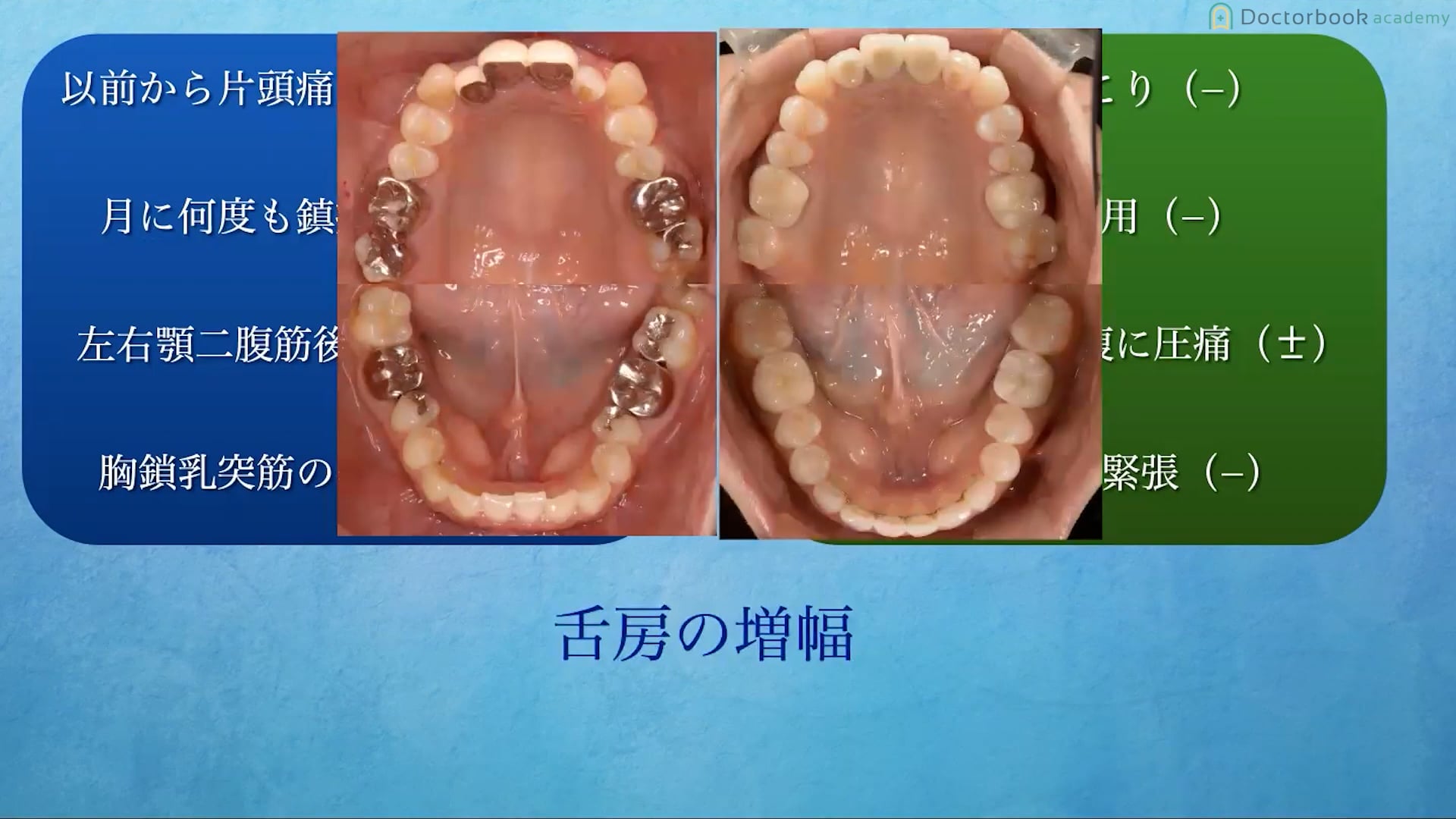 不正咬合における5つの診断指針と美しい顔貌に変化させる治療方法について