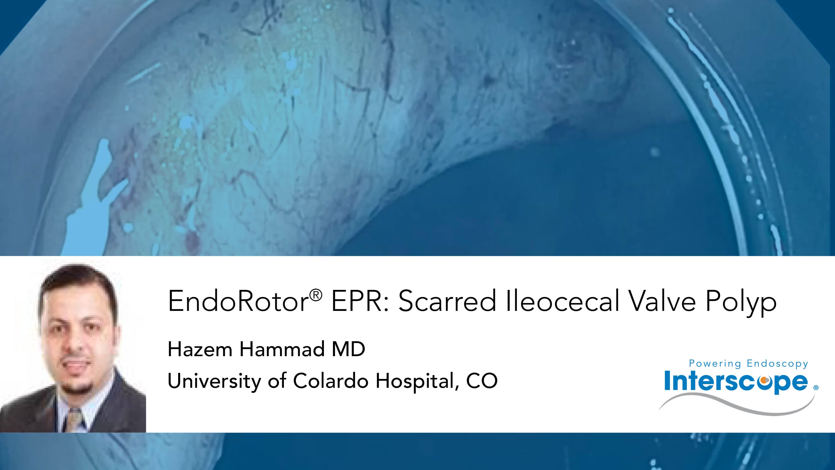 Endorotor epr scarred ileocecal valve polyp on vimeo