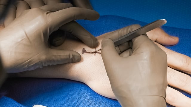 Scaphoid Nonunion Repair with Vascularized Distal Radius Bone Graft