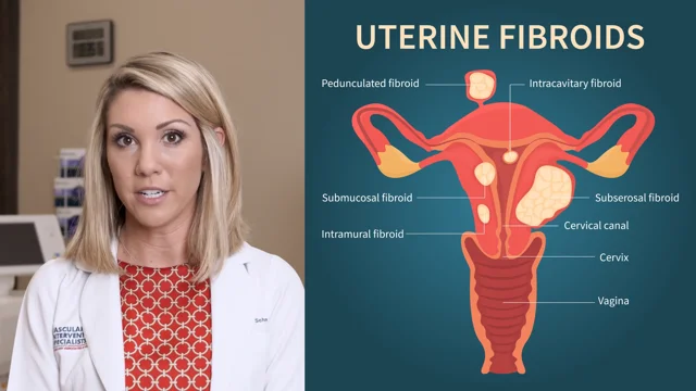 UFE là gì? Tìm hiểu về thuyên tắc xơ tử cung và lợi ích điều trị