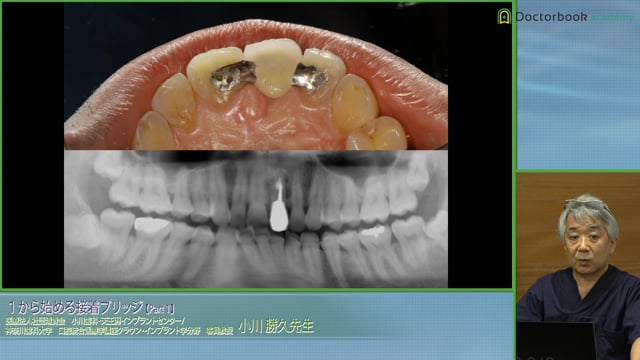 上顎右上1番 接着ブリッジ症例の治療方とラバーダムの重要性 #1
