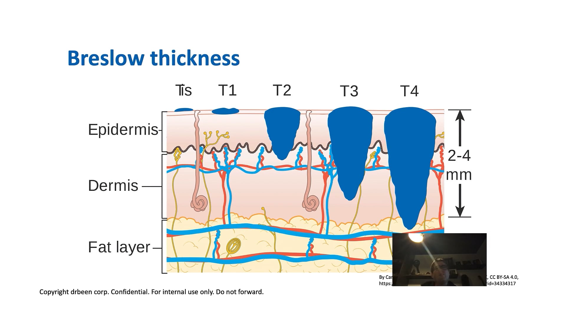 Melanoma by Dr. Thomas King