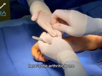 Arthritic CMC joint replaced by BioPRO prosthesis: Solution for base of the thumb arthritis