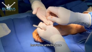 Arthritic CMC joint replaced by BioPRO prosthesis: Solution for base of the thumb arthritis