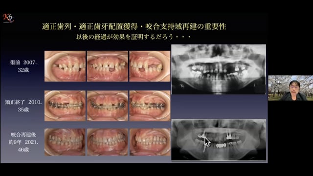 矯正と連携したIARPD症例と固定性補綴・可撤性補綴の選択基準 #1 