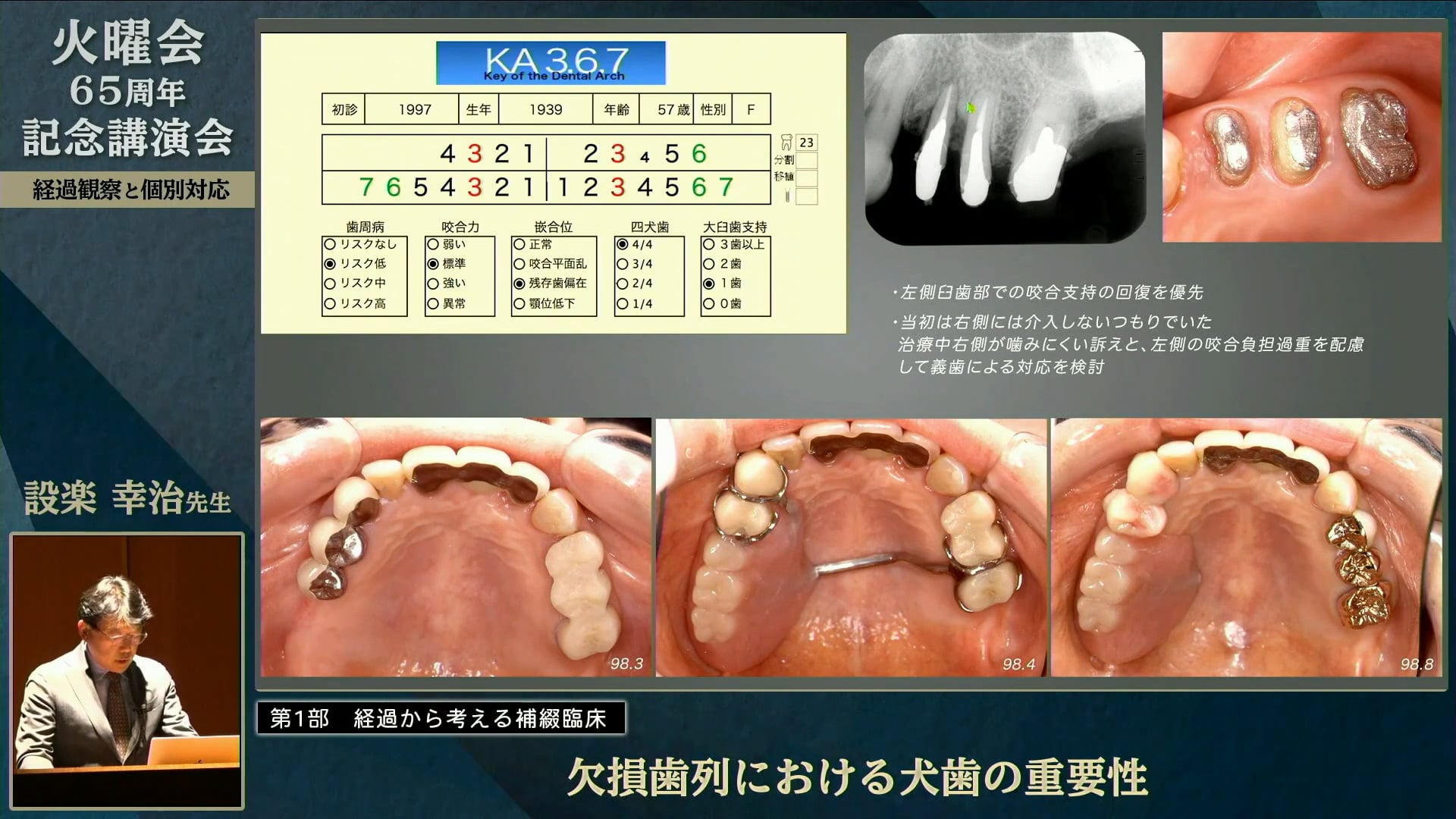 欠損歯列における犬歯の重要性│設楽 幸治先生