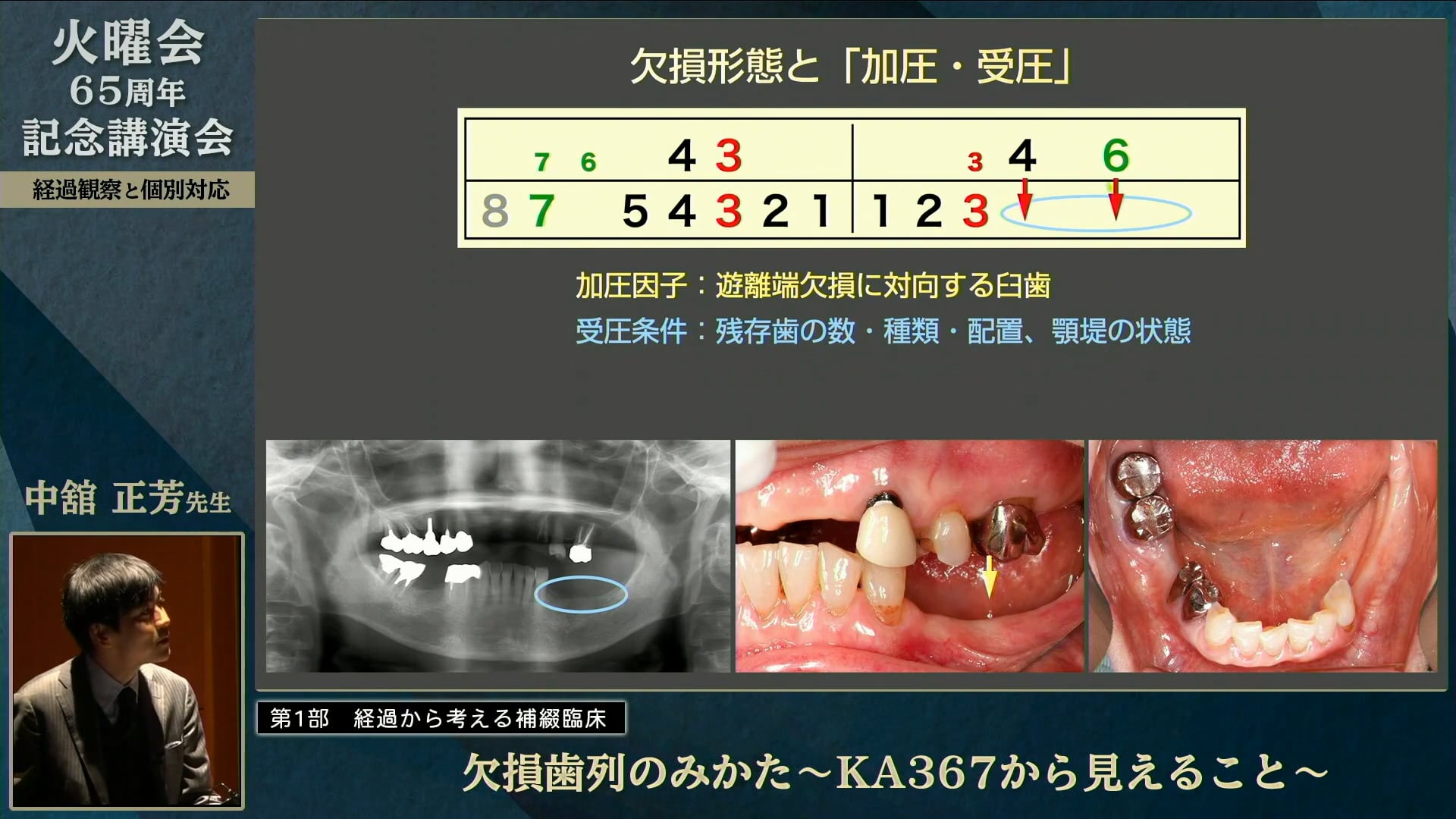 欠損歯列のみかた〜KA367から見えること〜│中舘 正芳先生