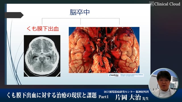 くも膜下出血に対する治療の現状と課題　Part1