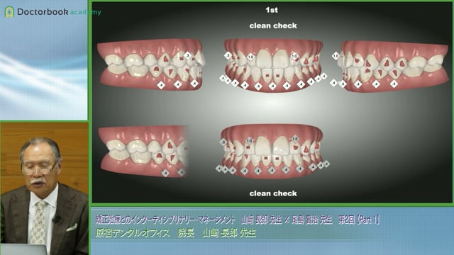 アライナーと補綴物を用いた審美矯正症例とBio Chemical Cleaning│山﨑長郎先生 #1