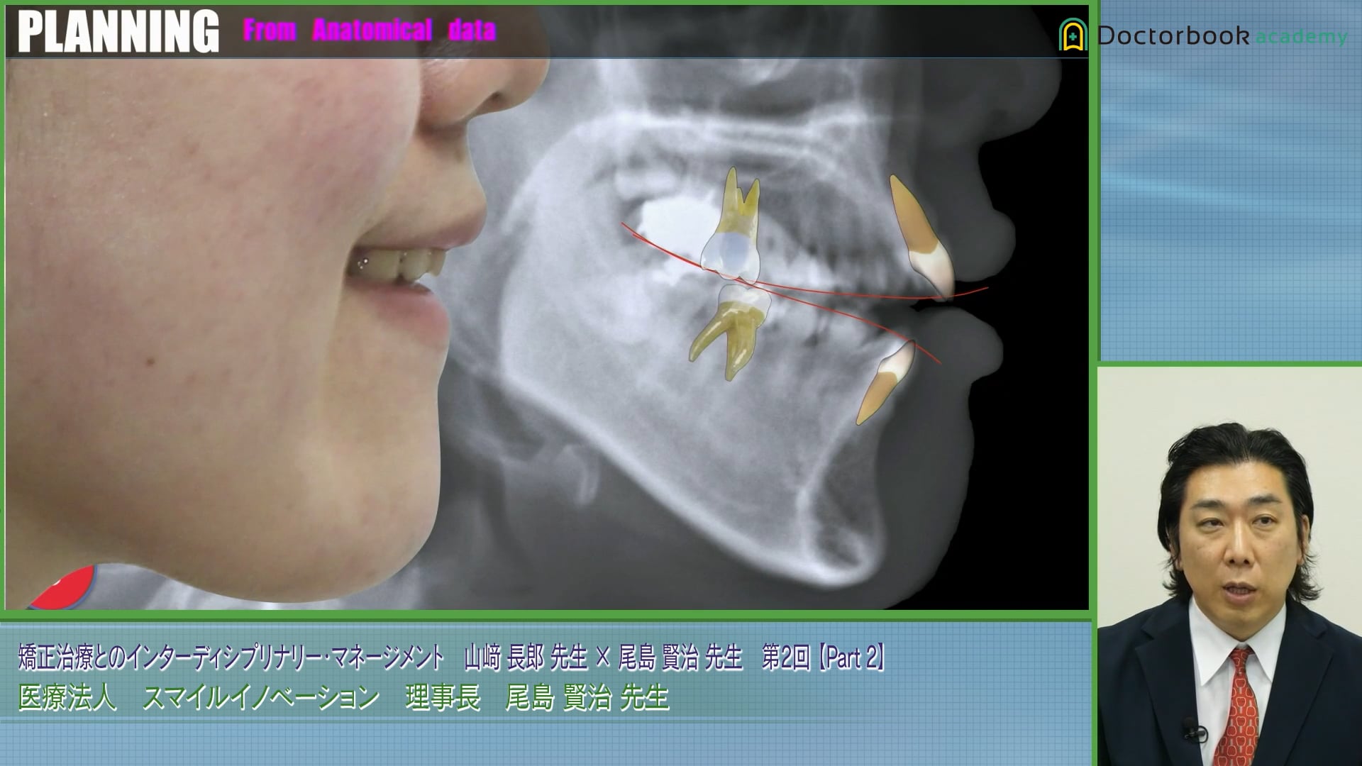 オープンバイト症例と抜歯が必要な叢生の難症例における治療プランの選択│尾島賢治先生 #2