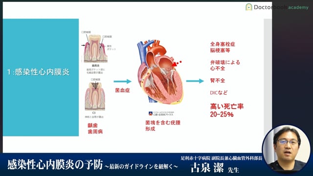 感染性心内膜炎の予防 ～最新のガイドラインを紐解く～