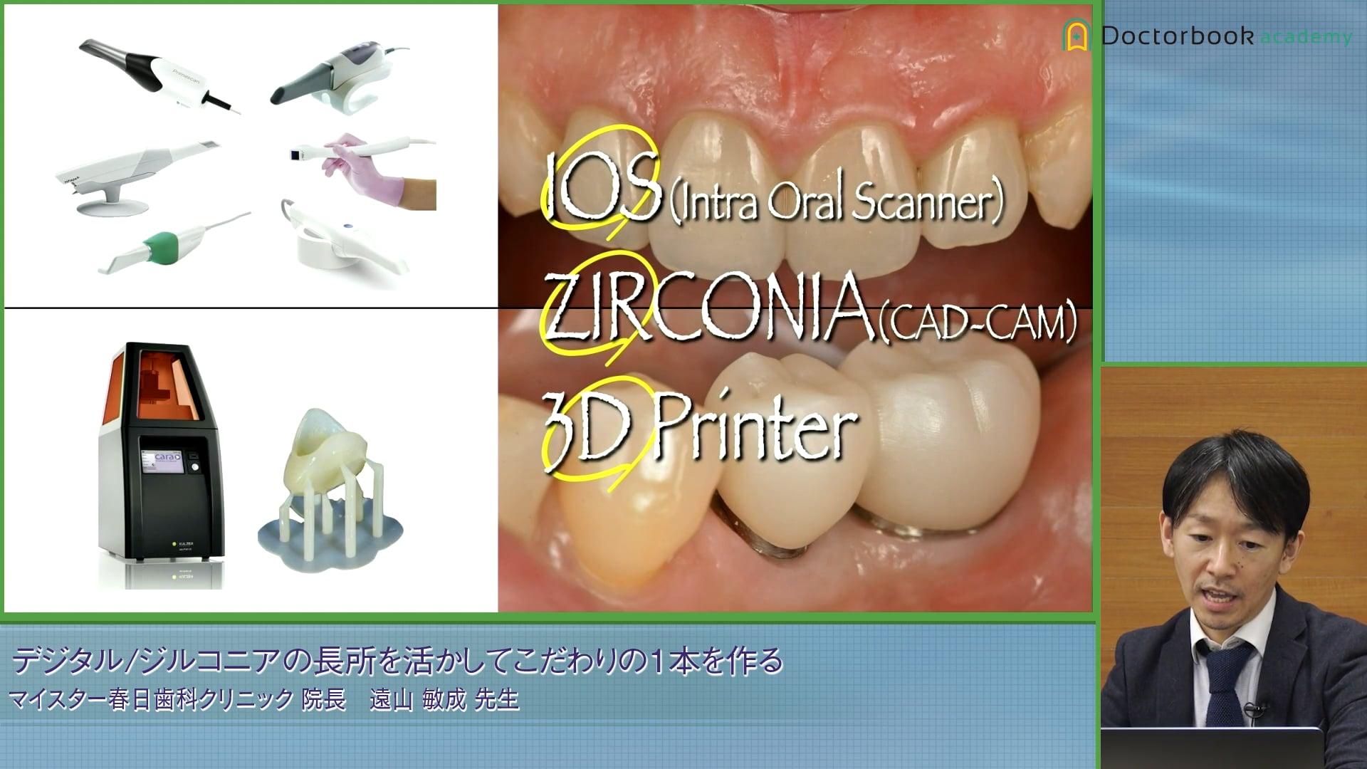 アナログ印象とデジタルスキャナーの比較とCAD/CAMを用いたクラウンデザイン #1