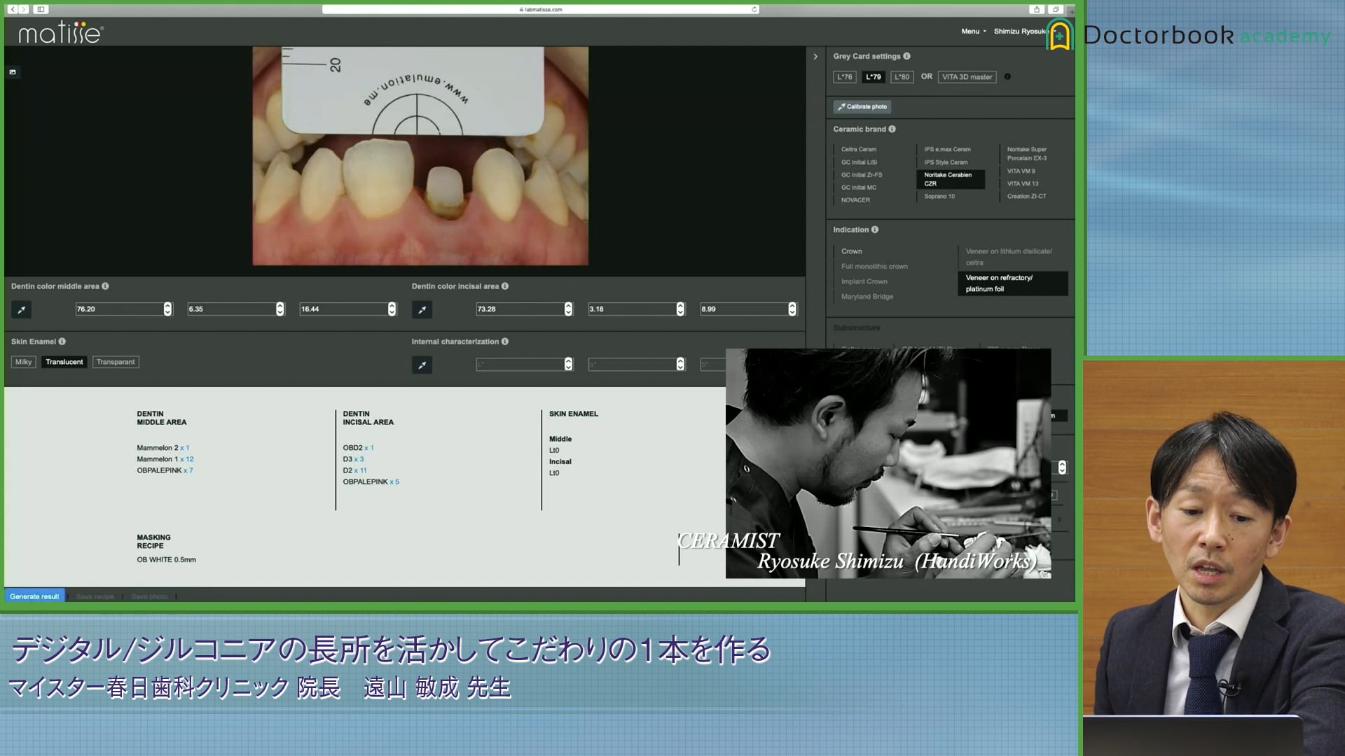 デジタルを活用した審美的プロビジョナルの作製とシェードマッチング #5