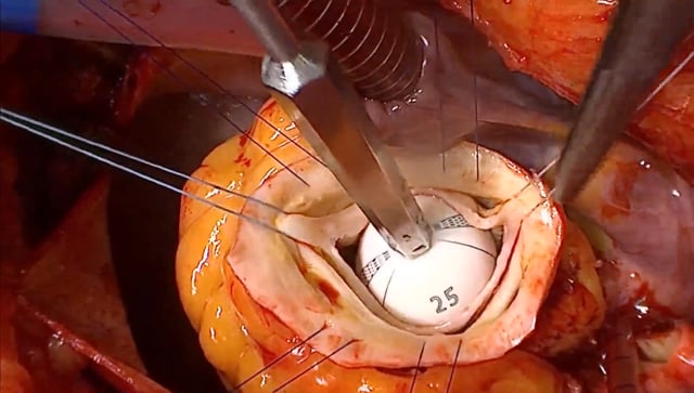 BAV Repair Associated with Ascending Aortic Aneurysm