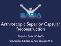 Arthroscopic superior capsular reconstruction for an irreparable rotator cuff tear