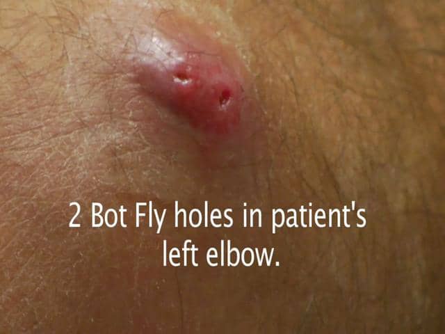 bot fly removal