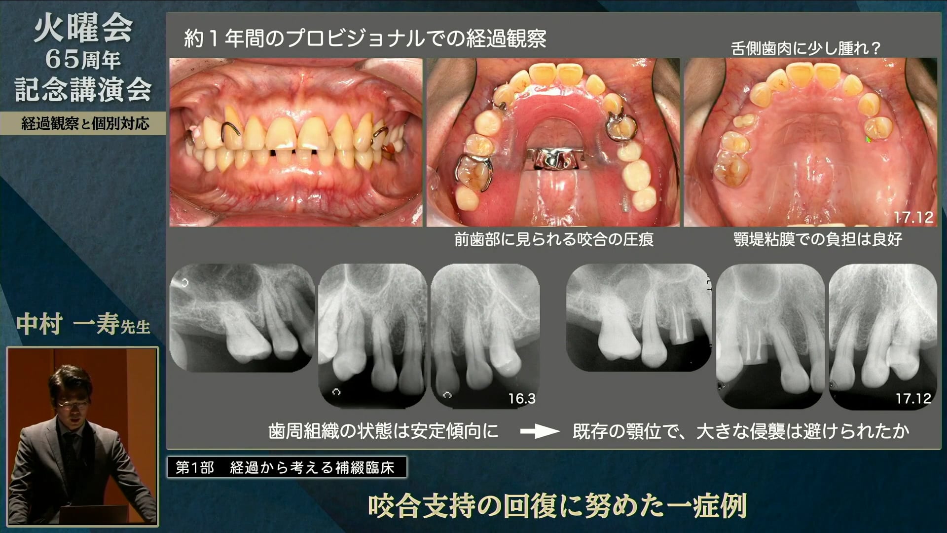 咬合支持の回復に努めた1症例│中村 一寿先生